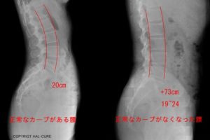 腰のカーブとストレートネック