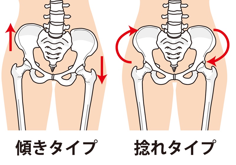 腰痛 ギックリ腰 神戸 ストレートネック矯正 Hal Cure