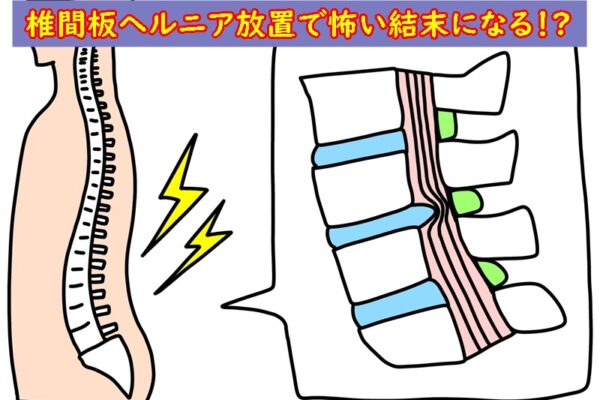 椎間板ヘルニアの原因放置で恐ろしい結末が待っているかも
